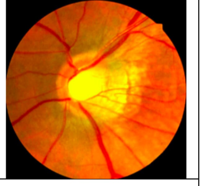 <p>acquired outpuching of posterior retina near ONH (may extend to macula) seen in very high myopes due to the stretching and increased axial length --&gt; weakens sclera and IOP pushes is out<br>-produces an enlarged blind spot<br>-Monitor --&gt; no tx unless CNVM</p>