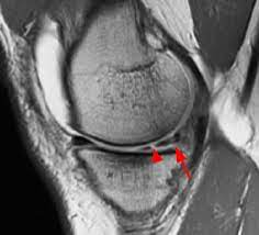 <p>tears of the menisci of the knee are common cause of knee pain. Acute trauma. degeneration due to chronic trauma. MRI is the modality of choice to image menisci tears.</p>