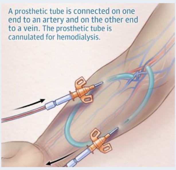 <p>synthetic tubing graft is surgically inserted under the skin to connect an artery and a vein&nbsp;</p><p>require 2-4 weeks of healing time before it can be used for HD</p><p>shorter access survival time, higher rates of infection and thrombosis&nbsp;&nbsp;</p>