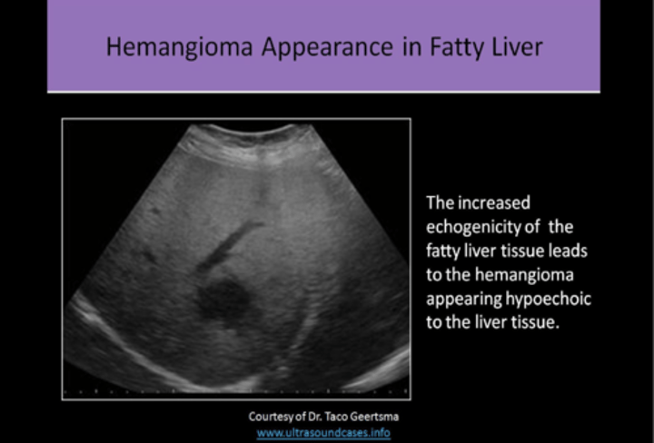 <p>1. FOCAL concentration of blood vessels<br>2. HOMOGENEOUS, HYPERECHOIC, WELL DEFINED BORDERS, POSTERIOR ENHANCEMENT<br>3. areas of DEGENERATION, NECROSIS, AND FIBROSIS demonstrated as HYPOECHOIC<br>4. MASS EFFECT<br>5. may appear HYPOECHOIC in a FATTY LIVER WITH INCREASED ECHOGENICITY<br>6. COLOR DOPPLER NOT USEFUL</p>