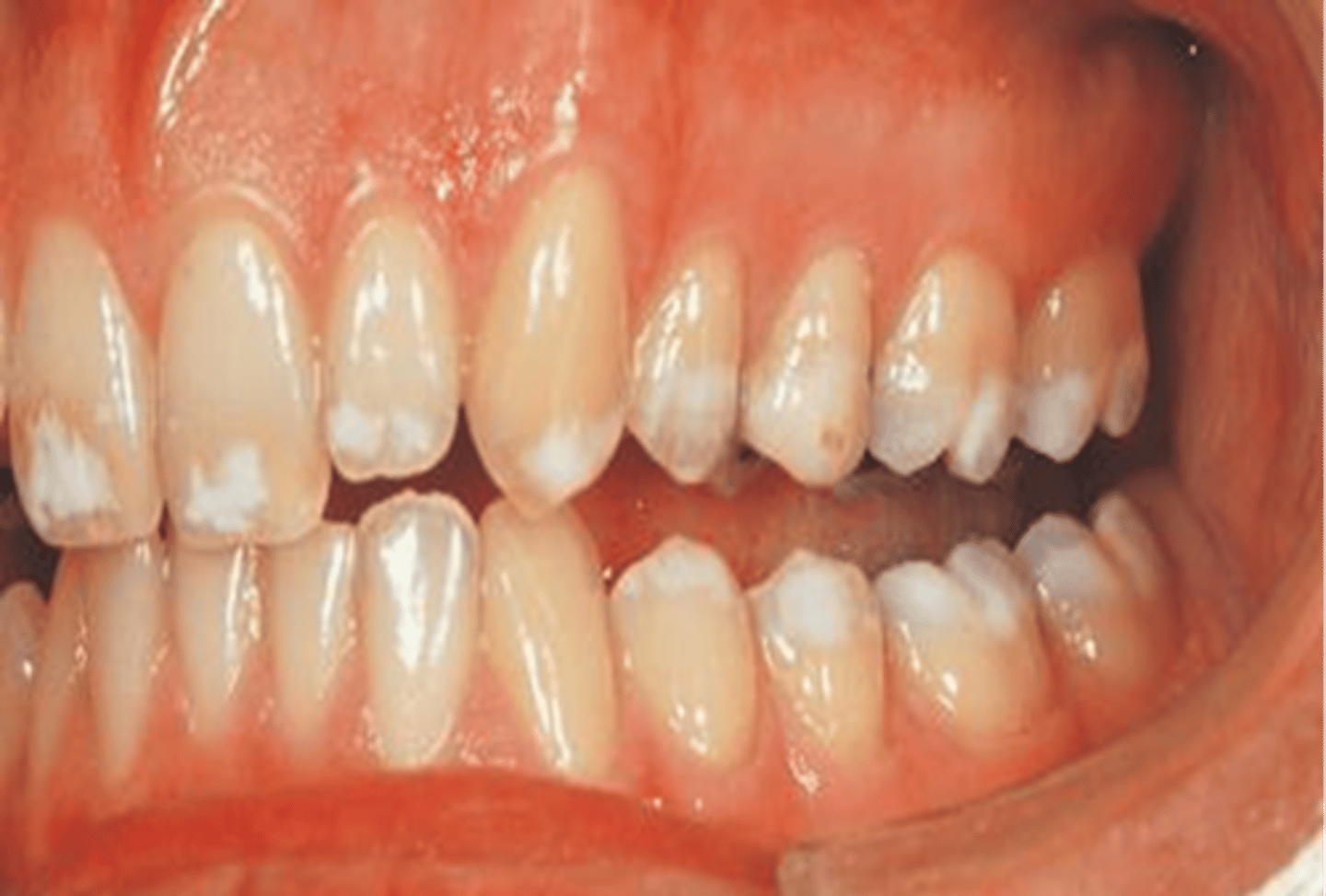 <p>incomplete or improper development of the enamel tissue</p><p>-Uniform white incisal edges and occlusal cusps</p>