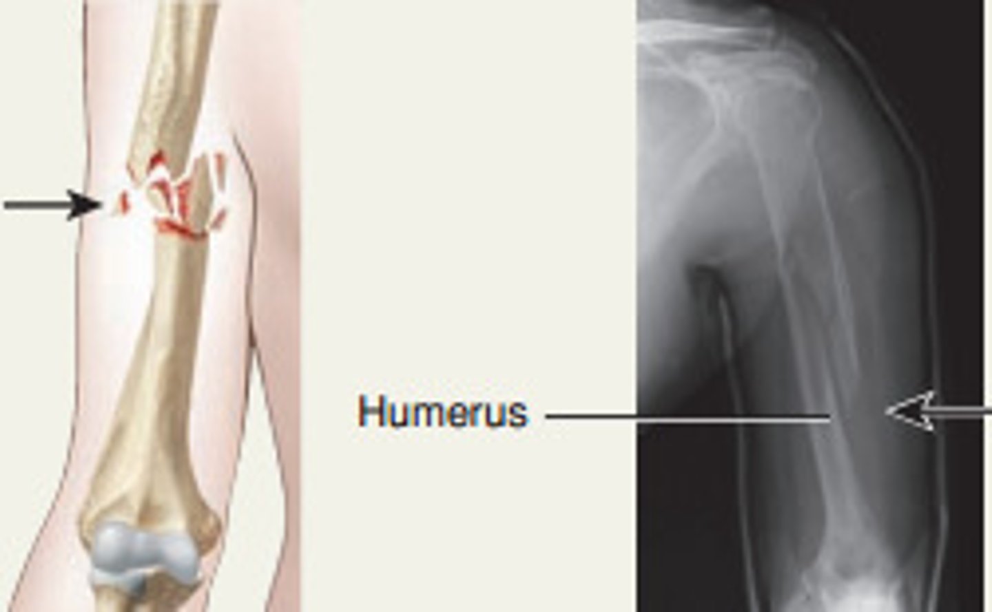 <p>fracture in which the bone is splintered or crushed</p>