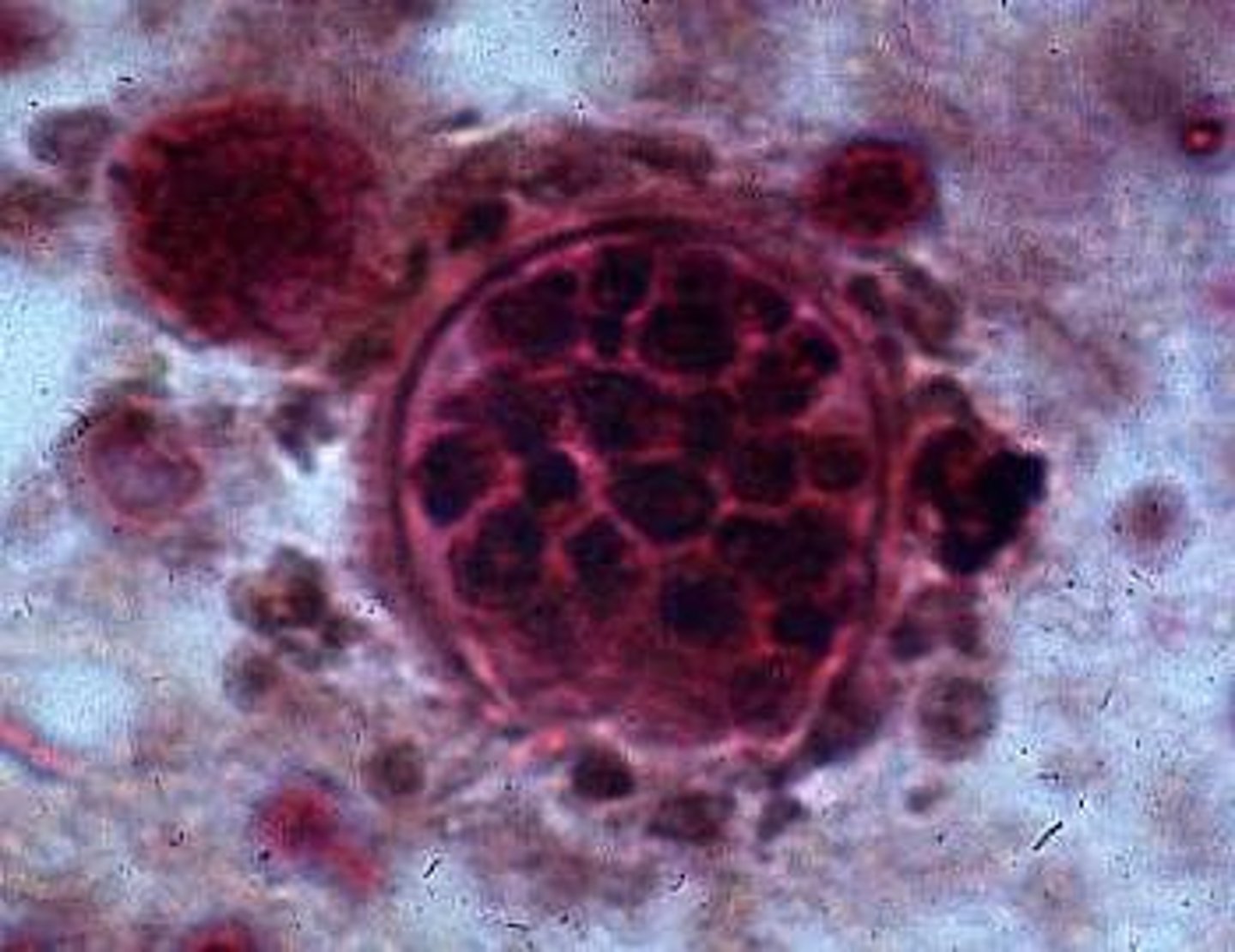 <p>COCCIDIODES</p><p>-valley fever!</p><p>-filamentous fungi in culture</p><p>-no YEAST like colonies in direct, instead spherules in tissue</p><p>-C immitis is Valley Fever, Cali San Joaquin valley</p><p>-C posadasii: SW US and mexico</p><p>-winds dissemintate the arthroconidia for many miles and inhaled</p><p>-athroconidia inhaled into lungs then transform in multinucleated spherical structures containing hundreds of endospores</p><p>-most are asymptomatic but some have rash + pneumonia</p><p>-if spreads it goes to lymph nodes, joints/bone, skin</p><p>-identify by spherules in smear with endospores inside</p>