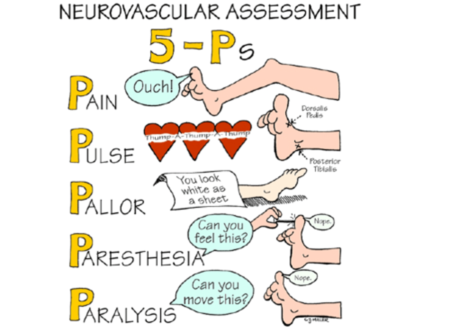 <p>6P's-Pain,Pallor,Pulselessness,Paralysis,Pressure,Paresthesia + poikilothermia, Mobility Assessment to detect early signs of compartment syndrome or vascular damage, Q1 after surgery.</p>