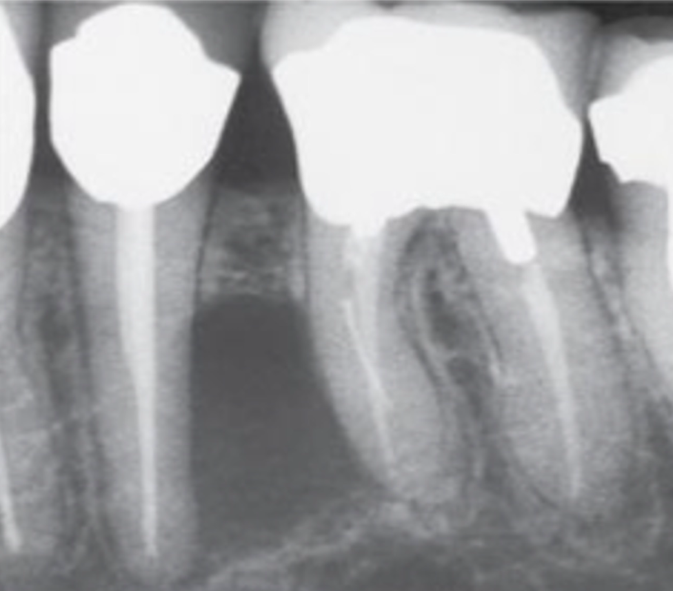 <p>same disease entity as apical periodontitis </p><ul><li><p>lesions form on lateral portion of root</p></li><li><p>pulp has lateral canals which are often microscopic</p></li><li><p>bacteria may be in lateral canals</p></li></ul><p></p>