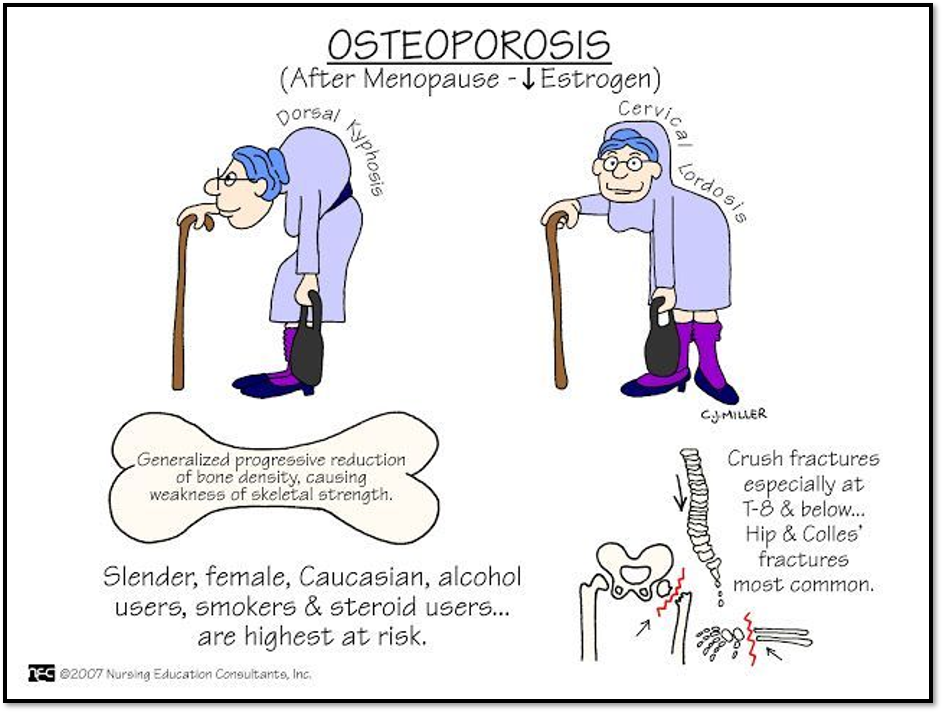 <p>Osteoporosis: <span>Etiology and pathophysiology</span></p>