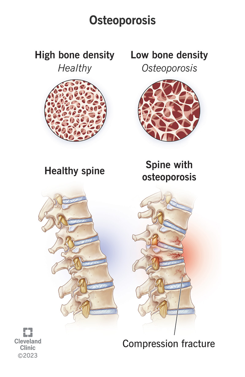 <p>A bone disease developing when bone mineral density and bone mass decreases or when the structure and strength of bone changes. The decrease in bone strength makes them more fragile and prone to breaking. Symptoms include back pain and poor posture.</p>