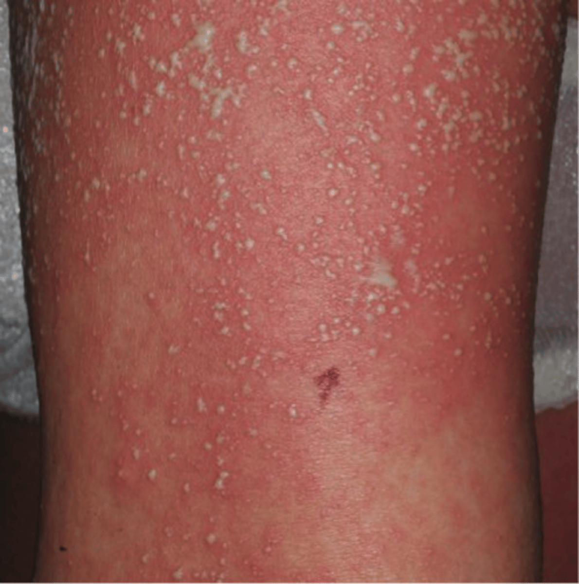 <p>acute pustular eruption PLUS fever and diffuse erythema that can appear within days</p>
