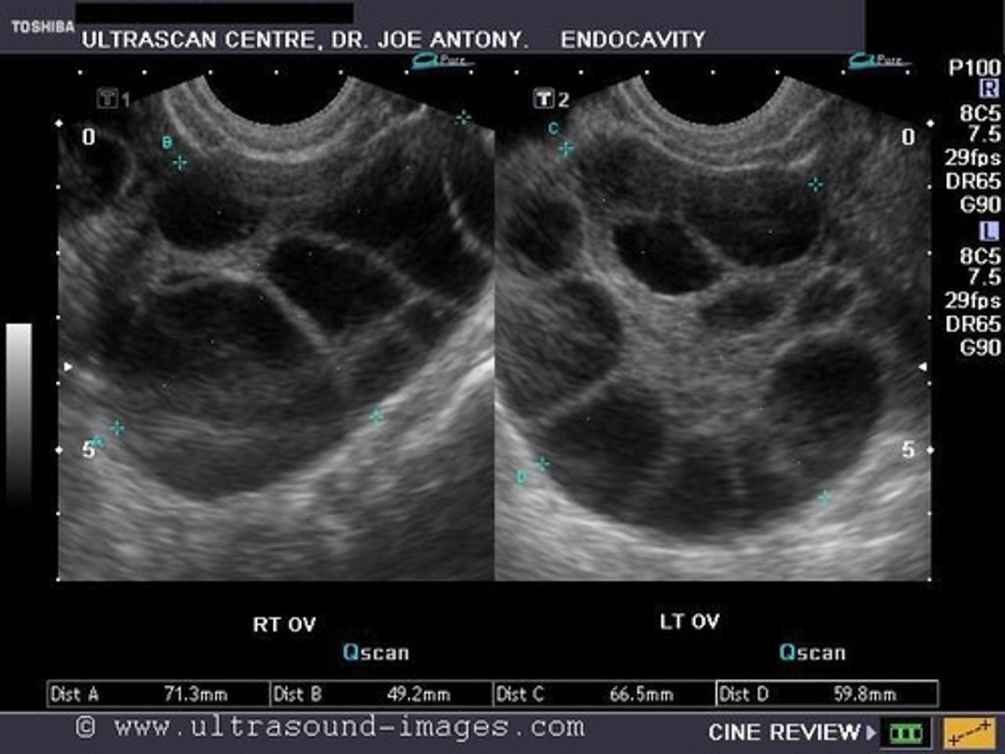 <p>ovarian hyperstimulation syndrome (OHSS)</p>
