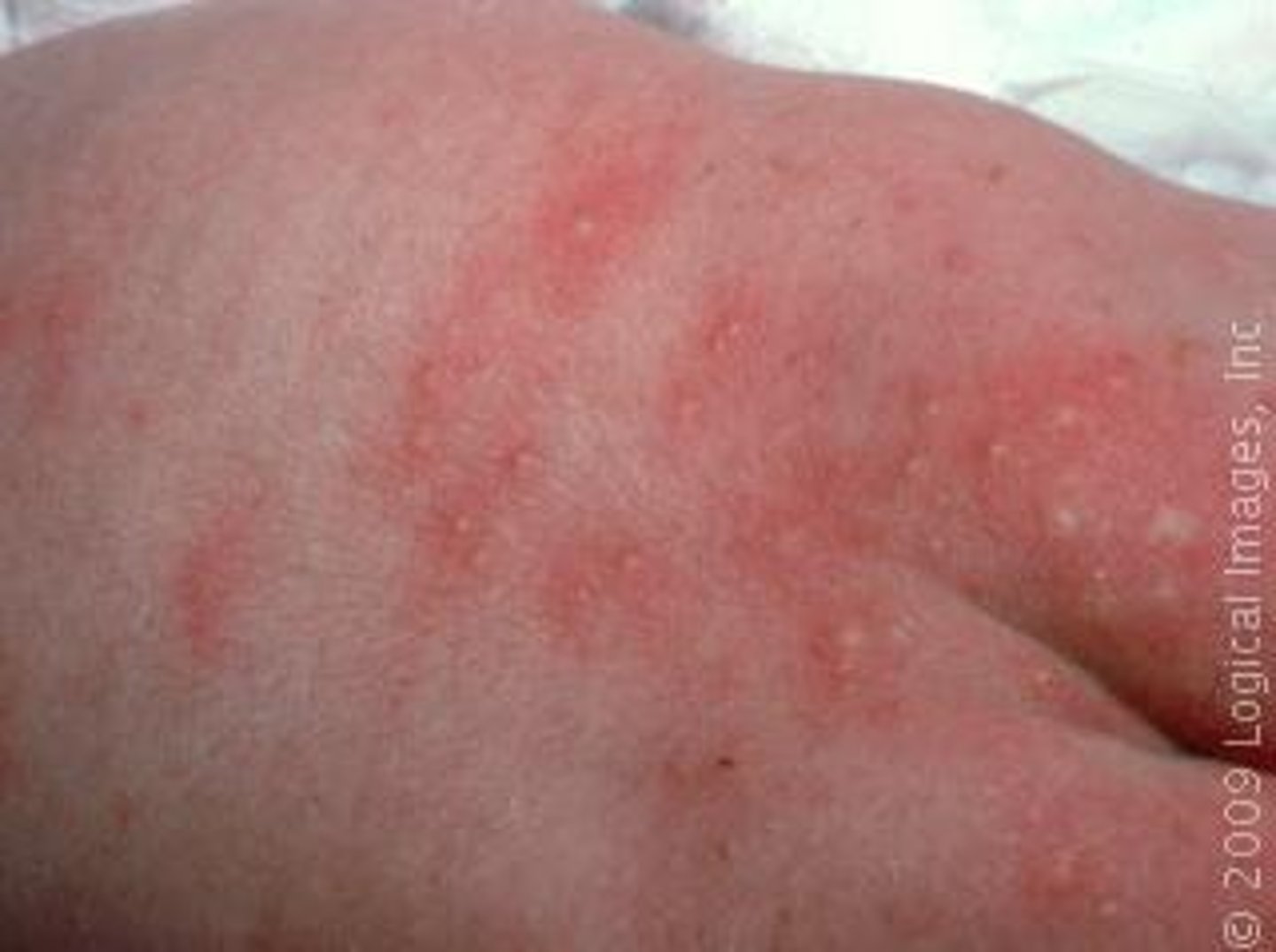<p>- most common "rash" in newborn nursery</p><p>- presents 24-28 hours after birth</p><p>- pustules on an erythematous base</p>