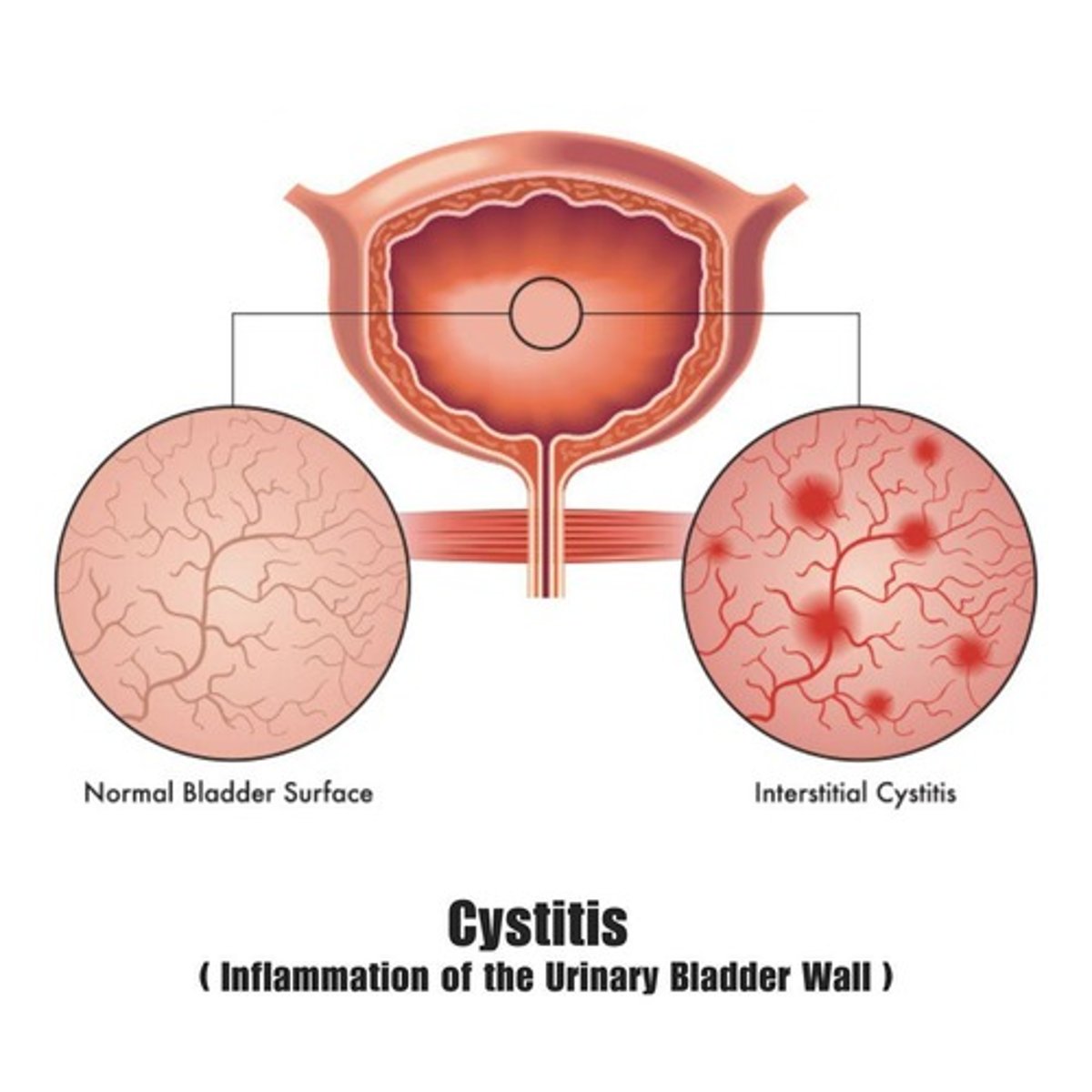<p>Inflammation of the urinary bladder; most common type of UTI; most common cause is Escherichia coli.</p>