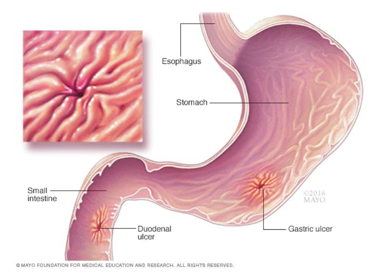 <ul><li><p>H. pylori</p></li><li><p>NSAIDs (Non-steroidal Anti-Inflammatories)</p></li><li><p>Stress</p></li><li><p>Smoking</p></li><li><p>Alcohol</p></li><li><p>Genetics</p></li></ul><p></p>