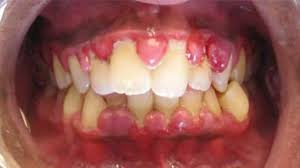 <p>bacterial infection→gum inflammation→gum overgrowth</p><p>CM: swollen masses<br>may cover teeth<br>associated inflammation→±redness</p>