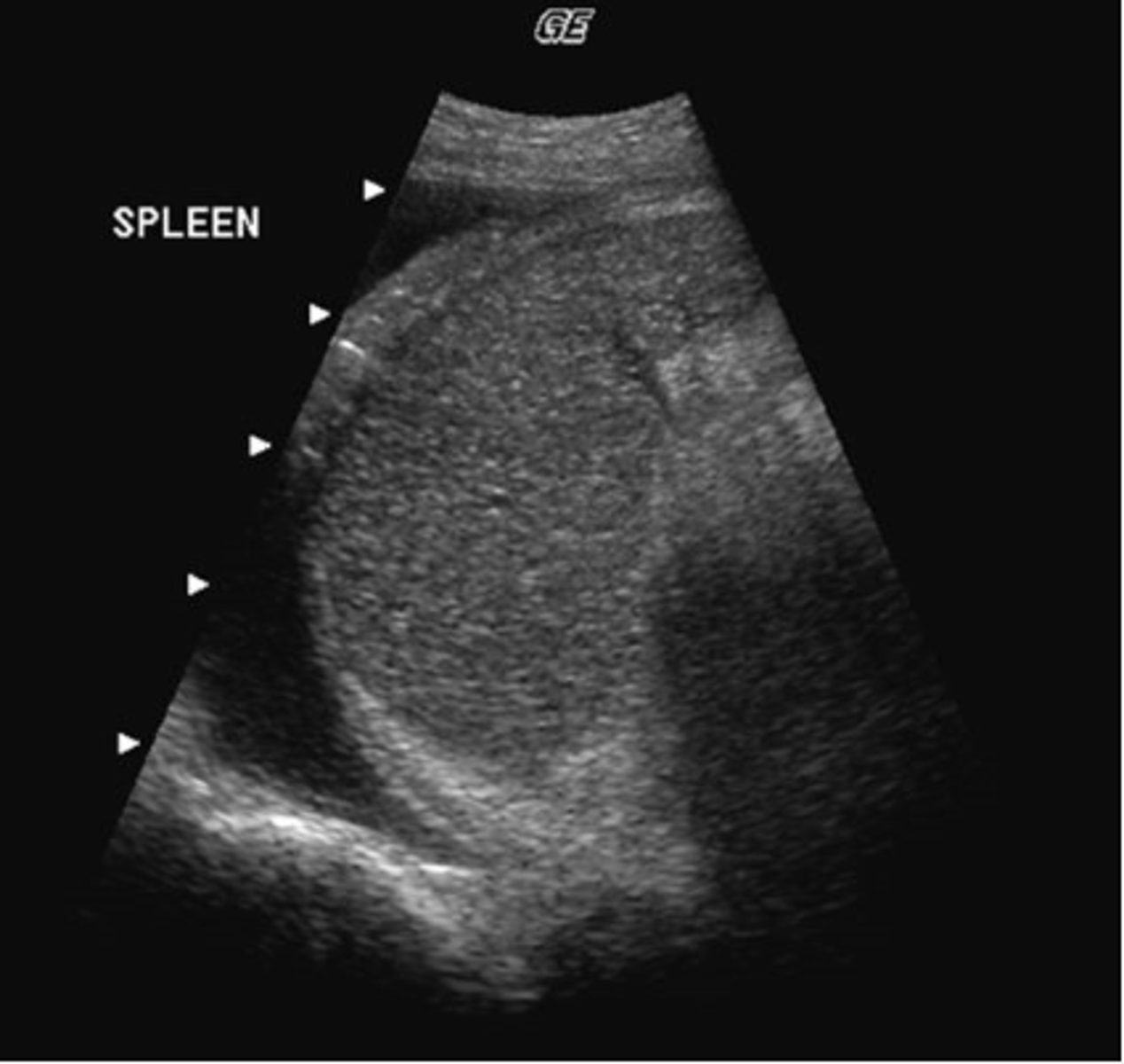 <p>What pathology is present in this image obtained from the left upper quadrant?</p><p>a. pleural effusion</p><p>b. splenomegaly</p><p>c. ascites</p><p>d. splenic metastases</p><p>e. splenic cysts</p>