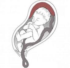 <p>Cord Prolapse</p>