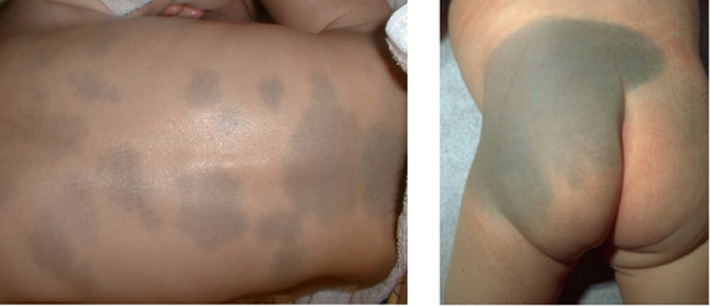 <p>Mongolian spots -> usually fade spontaneously</p><p>-> document these as they can be mistaken for bruises</p>