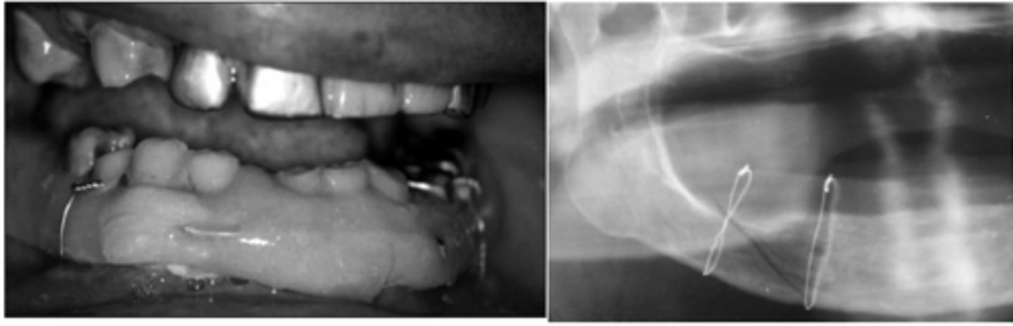 <p>circummandibular wiring</p><p>- wire is passed around the body of the mandible with a large needle</p><p>- 1 end of the wire is introduced lingually and passes bucally</p><p>- wire is tightened around the plate of the patients denture</p>