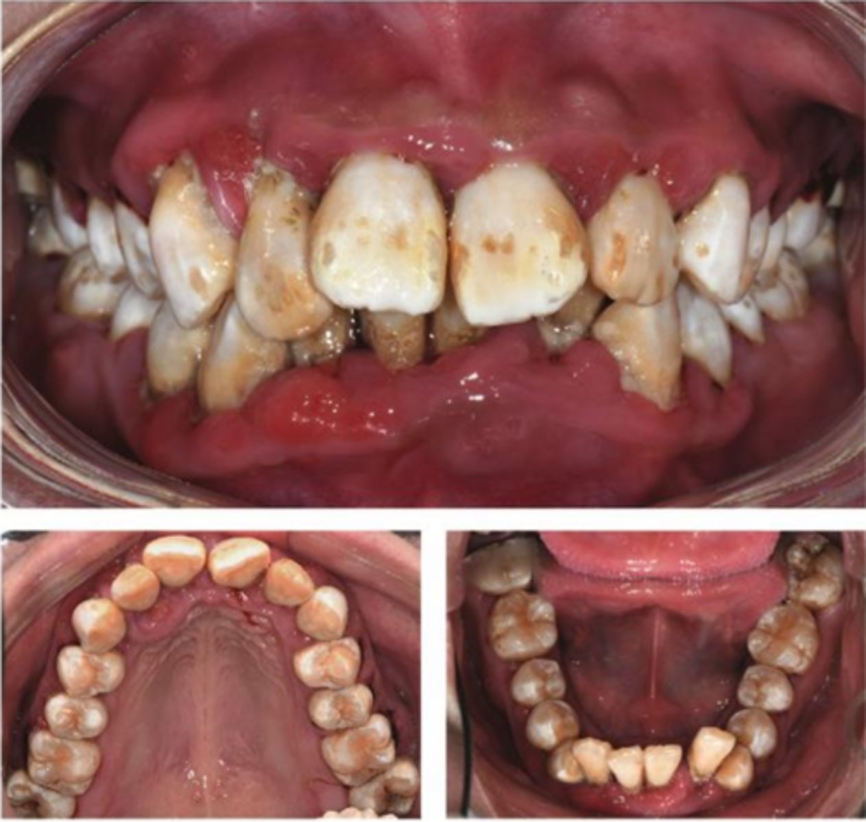 <p>A 21-year-old female was referred to the dental center, complaining of halitosis and swollen and painful gums, which lasted 2 months. The patient has a history of diabetes, which was diagnosed around 11 years ago.</p><p>Are there any other questions you would like to ask the patient?</p>
