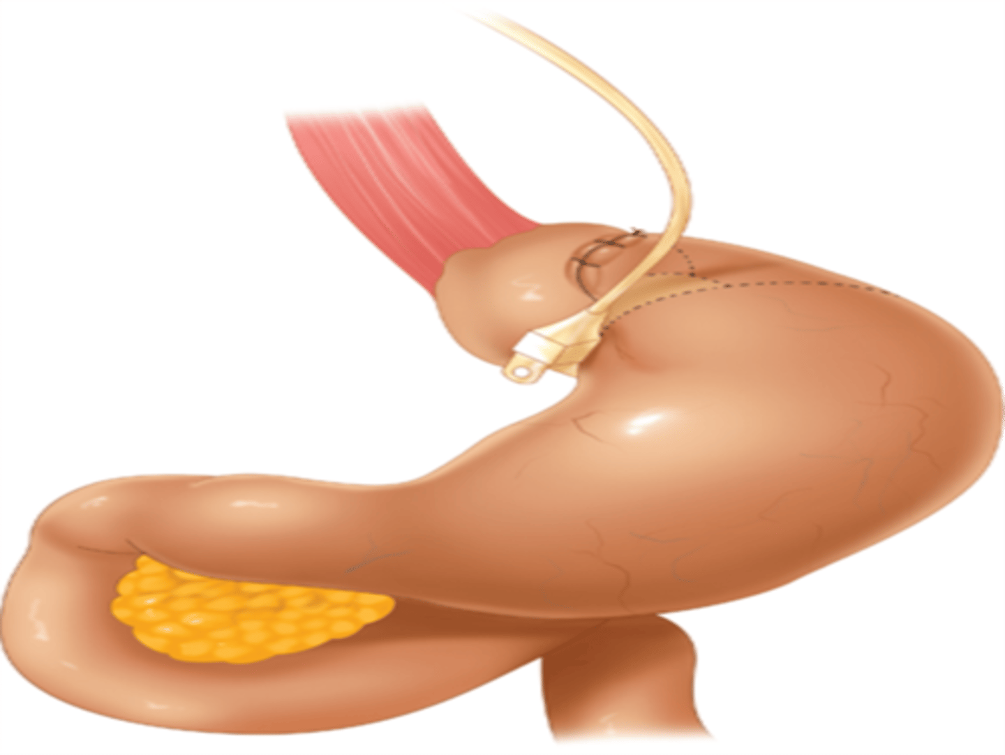 <p>LAGB (laparoscopic adjustable gastric band)</p>
