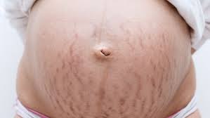<p>stretch marks </p>