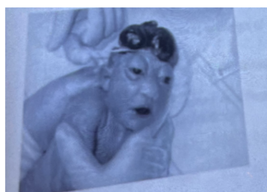 <p><strong>The above photo shows</strong></p><p>a. Hydrocephalus</p><p>b. Microcephaly</p><p>c. Acrania</p><p>d. anencephaly</p>
