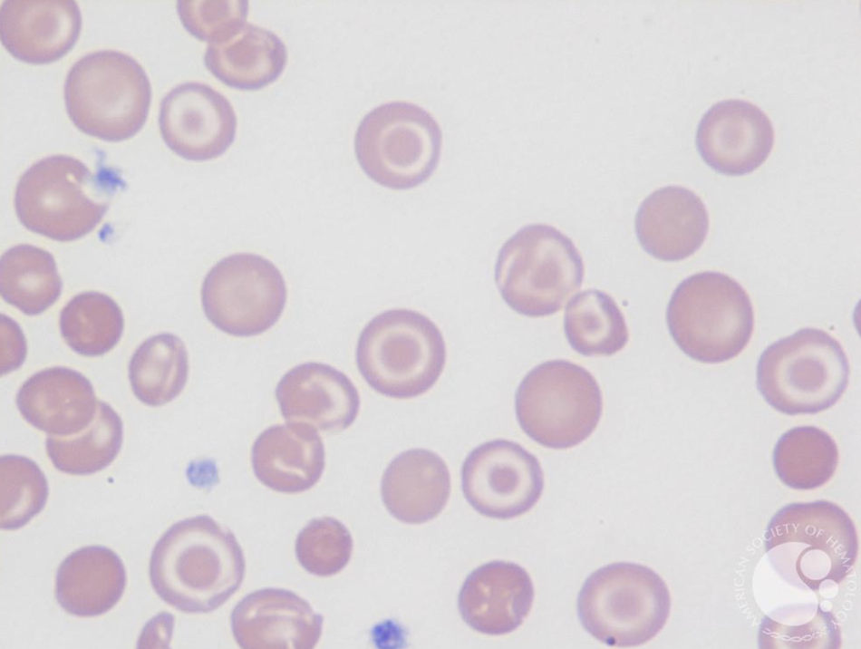 <p>What type of smear cell and what conditions is it seen in</p>
