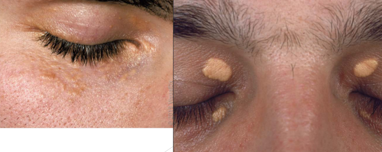 <p>xanthelasma</p>
