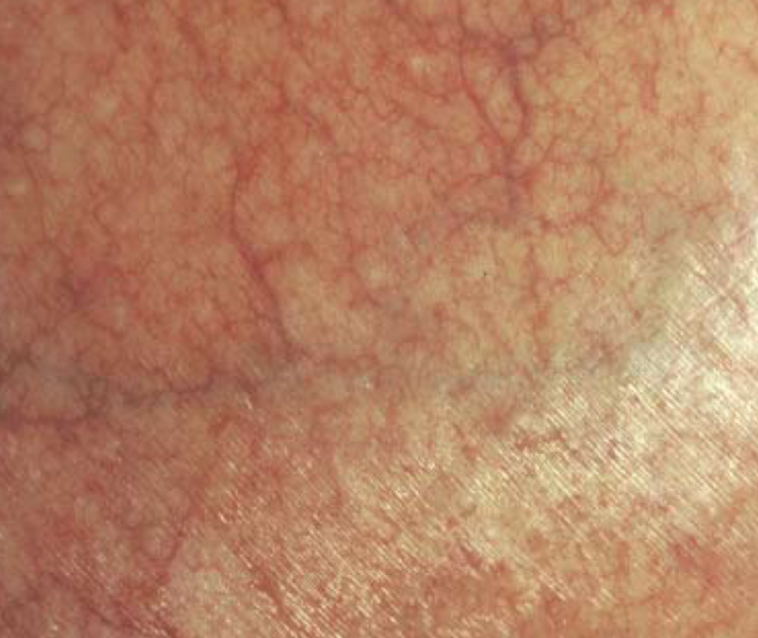 <p>what lesion and what condition is present</p>