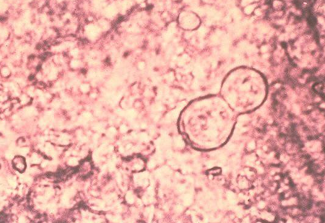 <p>-outbreaks often occur in individuals with exposure to decaying wood</p><p>-yeast form is 8-15 microns (much larger than Histoplasma), have thick walls, and reproduce by broad-based budding</p>