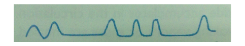 <ul><li><p>Irregularly interspersed periods of apnea in a disorganized sequence of breaths</p></li><li><p>Causes: trauma, stroke, damage or pressure to medulla oblongata</p></li><li><p>Medulla oblongata: where the control of respiration is located </p></li><li><p>Similarity with Cheyne-stokes: there’s an apnea in between</p></li><li><p>Has equal depths in the breathing pattern compared to Cheyne-stokes; depth is not increasing</p></li></ul><p></p>