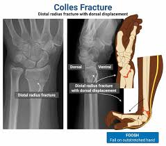 <p>distal 2 cm transverse fracture of radius with dorsal displacement and will have this type of_____ deformity</p>
