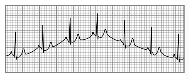 <p>an uneven or fluctuating EKG baseline that can obscure cardiac signals. </p>