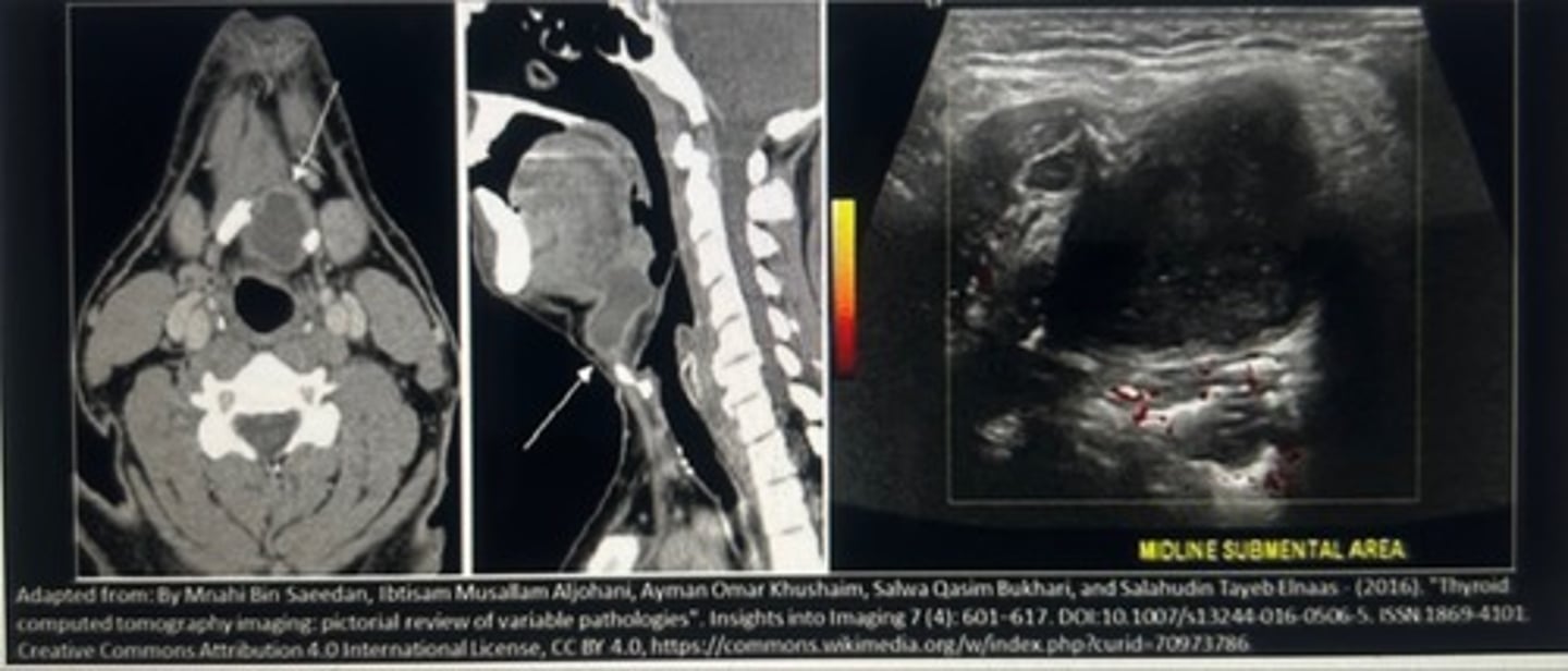 <p>Thyroglossal cyst</p><p>The CT images demonstrate a fluid filled mass in the anterior neck, just below the level of the mandible. Know that the cyst is darker gray, then all the surrounding soft tissue structures. This is consistent with fluid because it attenuates less radiation than the soft tissue. The ultrasound image demonstrates a cystic structure with internal debris and posterior enhancement. There is no related hypervascularity that is expected with inflammation. Due to the location of the structure in the imaging characteristics, the findings are most suggestive of a thyroglossal cyst.</p>