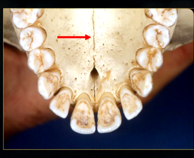 <p>what is this thin line over the palate?</p>