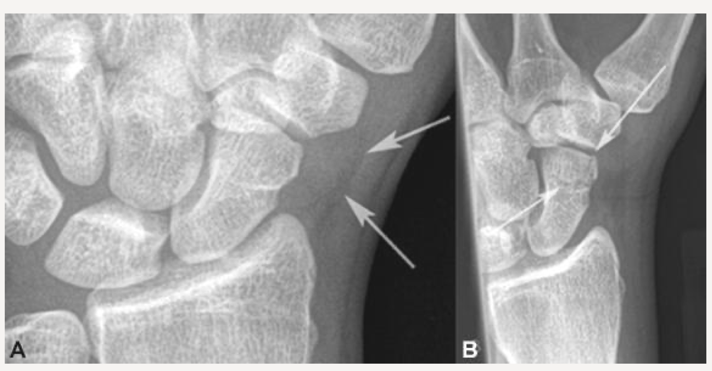 <p>looks black, sign of fracture or dislocation. On PA and oblique wrist projections</p>