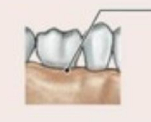 <ul><li><p>Synarthrotic joint (Immovable joint)</p></li><li><p>Binds teeth to bony sockets</p></li><li><p>Fibrous connection is periodontal</p></li></ul>