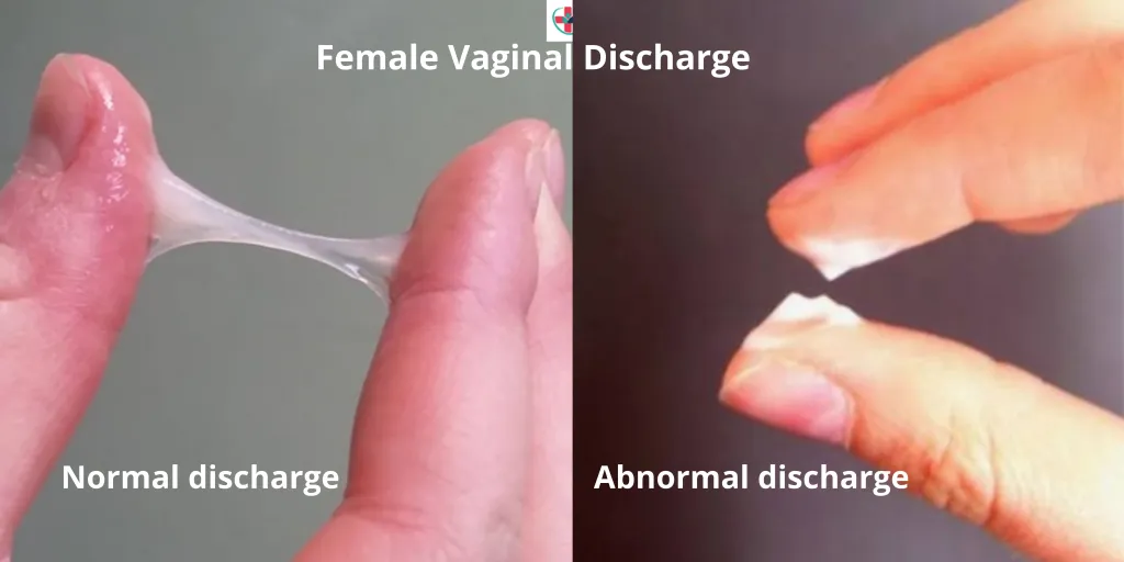 <p><strong>Creamy and purulent (pus-like) discharge from the urethra.</strong></p><ul><li><p>Primary site in women: cervix</p></li><li><p>Primary site in men: urethra</p></li></ul><p></p>