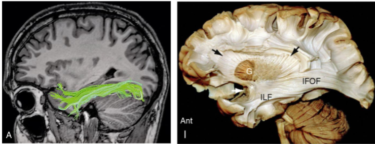 <p>Inferior Longitudinal Fasciculus (ILF)</p>