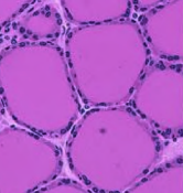 ### Hyperplasia - *Hyperthyroidism*