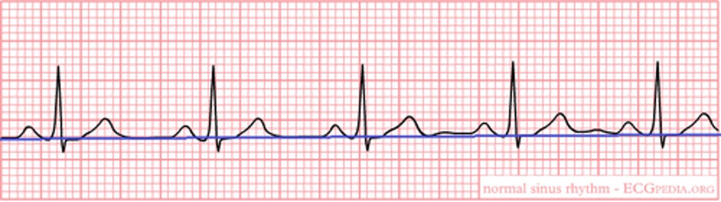 <p>The straight line on the tracing btwn cardiac cycles where there's no ♡ electrical activity or deflection</p>