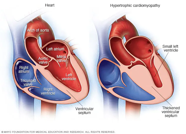 <p>abnormal structure and function of the heart related to heart muscle </p><ul><li><p>think of a closed system (P1V1 = P2V2)</p></li></ul><p></p>
