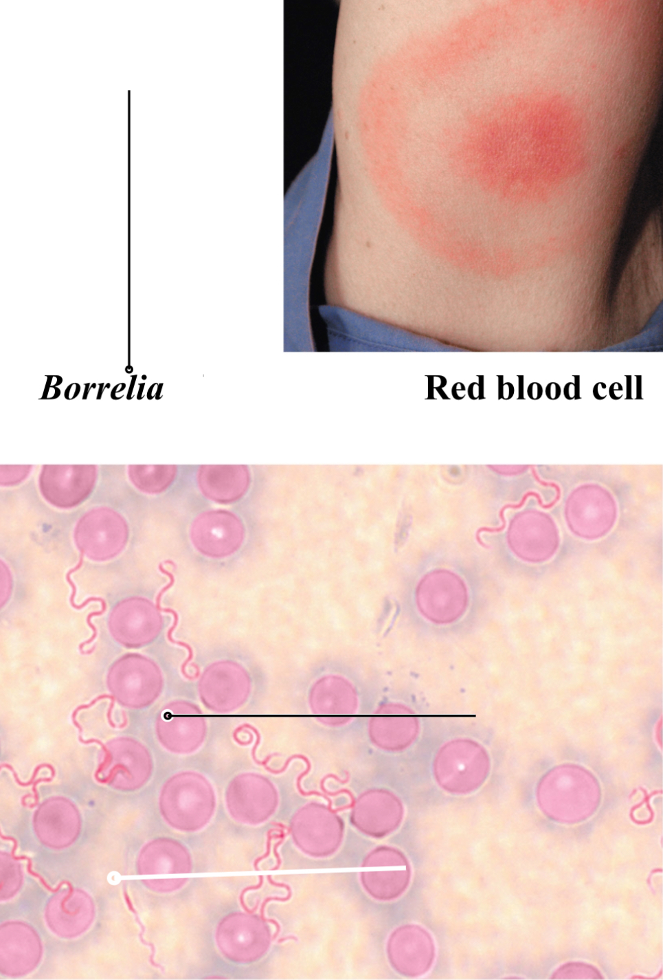 <p><span><span>Signs and symptoms: Bulls-eye lesion</span></span></p><p><span style="background-color: transparent;"><u><span>Early:</span></u><strong><span> bulls-eye lesion</span></strong><span>, headaches,</span><strong><span> </span></strong><span>dizziness, </span><strong><span>stiff neck</span></strong><span>, </span><strong><span>severe fatigue</span></strong><span>, chills</span></span></p><p><span style="background-color: transparent;"><u><span>Middle: </span></u><span>10% of patients experience </span><strong><span>neurological symptoms</span></strong><span> and </span><strong><span>cardiac dysfunction</span></strong></span></p><p><span style="background-color: transparent;"><u><span>Final:</span></u><span> 80% of patients experience</span><strong><span> severe arthritis</span></strong><span> (may last years); rarely fatal</span></span></p><p><br>Vector: deer tick </p>