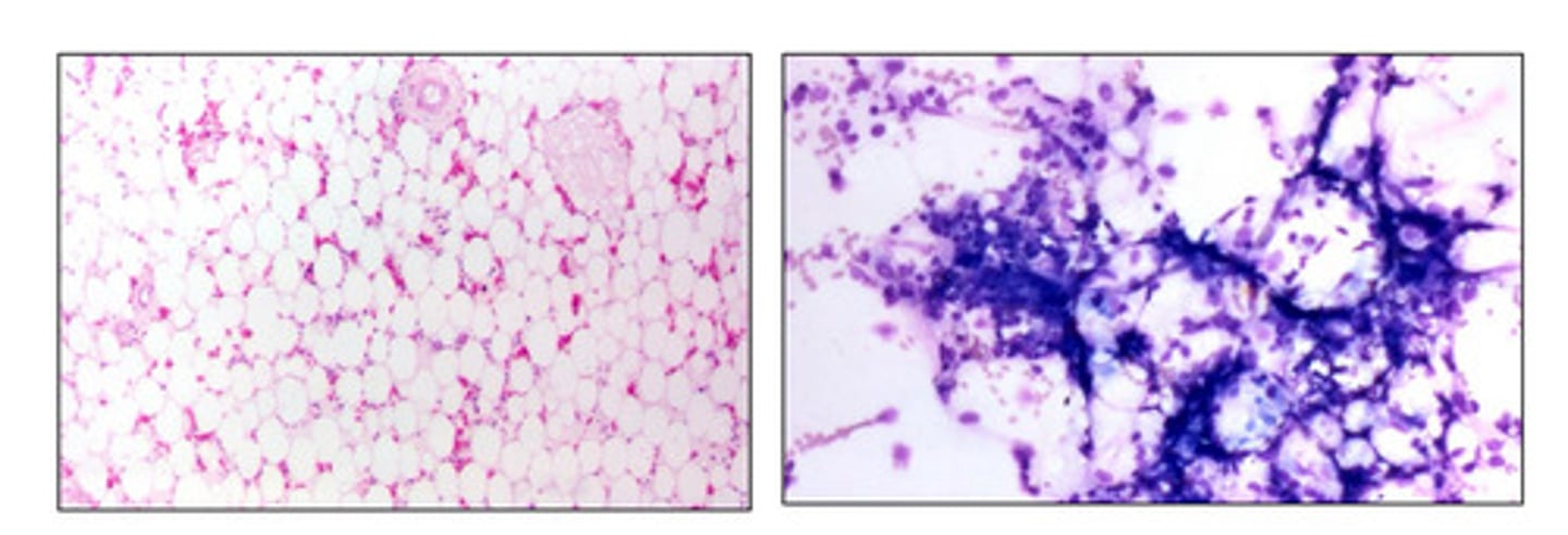 <p>If bone marrow particles, on average, are > 75 % adipose tissue</p>