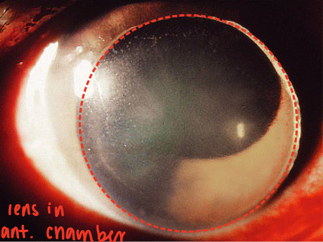 <ul><li><p>displacement of lens d/t blunt&nbsp;<em>trauma</em></p></li><li><p><strong>Pathophys</strong>:</p><ul><li><p><span><span>Blunt trauma compresses the eye in the anterior-posterior direction</span></span></p></li><li><p><span><span>compression causes the eye to expand laterally, superior and inferior</span></span></p></li><li><p><span><span>zonules to stretch and eventually rupture</span></span></p></li><li><p><span><span>Lens movement will be dependent on:</span></span></p><ul><li><p><span><span>Complete zonular rupture = dislocation</span></span></p></li><li><p><span><span>Incomplete zonular rupture = subluxation, lens will move towards intact zonules</span></span></p></li></ul></li></ul></li><li><p><span><strong><span>Symptoms</span></strong><span>:</span></span></p><ul><li><p><span><span>Monocular diplopia (diff focusing pts)</span></span></p></li><li><p><span><span>Distant blurred vision due to increase in astigmatism and myopia</span></span></p><ul><li><p>high hyperopia may also be seen</p></li></ul></li><li><p><span><span>Near blurred vision due to loss of accommodation</span></span></p></li></ul></li><li><p><span><strong><span>Presentation</span></strong><span>: lens subluxation or dislocation</span></span></p><ul><li><p><span><span>lens can free float in the posterior chamber or migrate to anterior chamber</span></span></p><ul><li><p><span><span>When the lens moves to the anterior chamber, the patient is at risk for glaucoma</span></span></p></li></ul></li></ul></li><li><p><span><strong><span>Treatment</span></strong><span>:</span></span></p><ul><li><p>Refractive error correction</p></li><li><p>lens extraction</p></li><li><p>tx of complications - glaucoma</p></li></ul></li></ul><p></p>