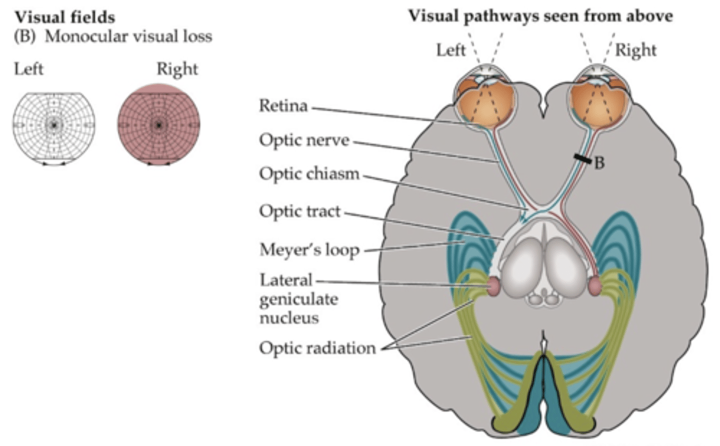 <p>R monocular vision loss</p>
