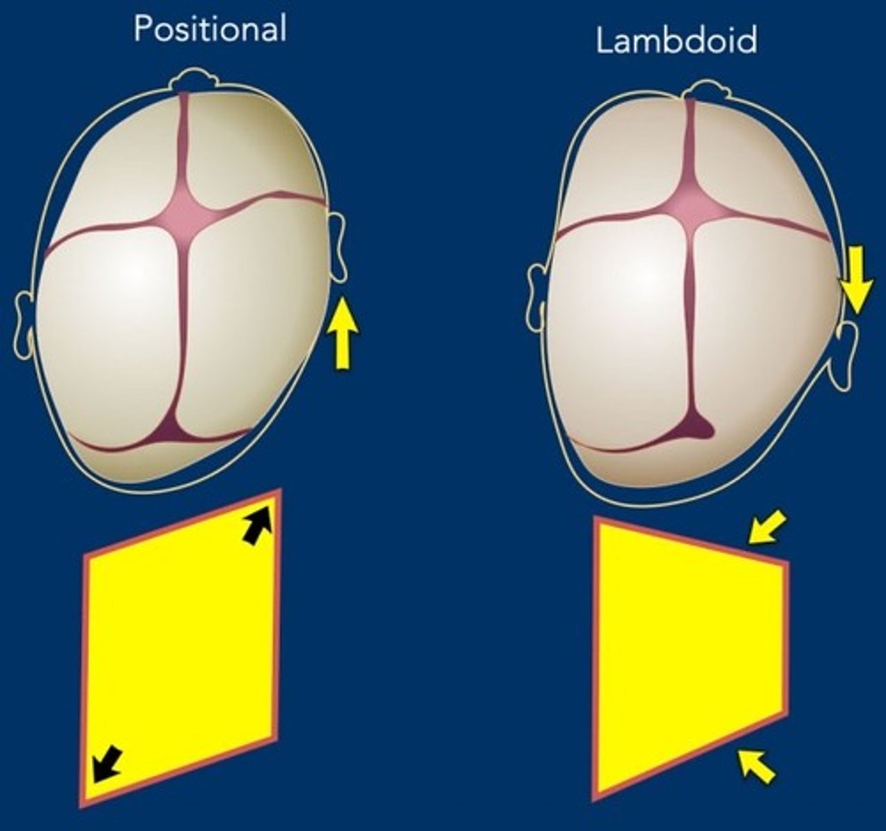 <p>- positioneel -> unilat oor naar voor</p><p>- lambdoid -> unilateraal oor naar achter</p>