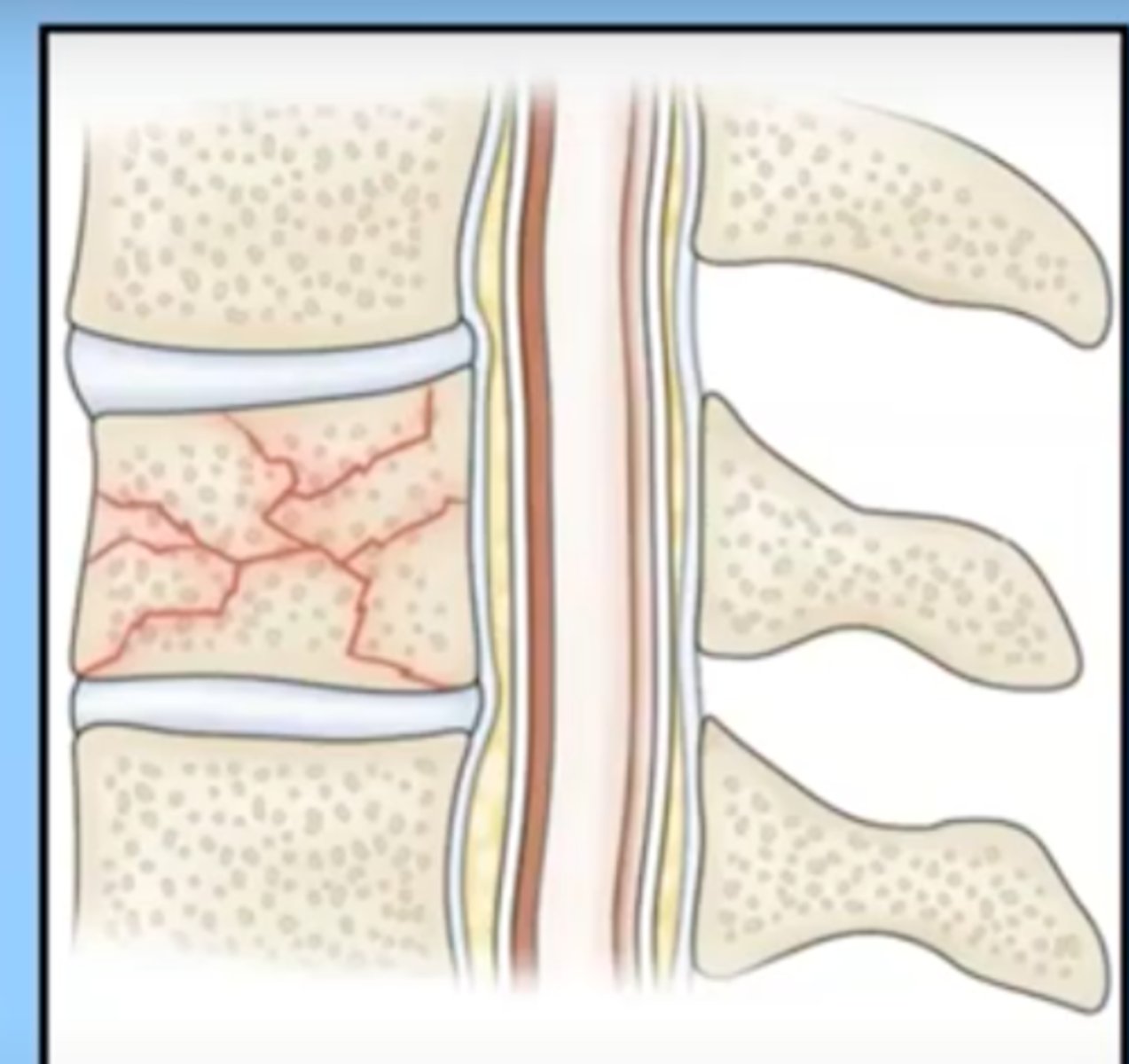 <p>occurs when the bone is pressed together (compressed) on itself</p><p>seen in vertebral fractures, very common in osteoporosis (getting shorter)</p>