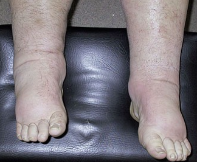 <ul><li><p>Proteinuria (&gt;3.5g/24 hours)</p></li><li><p>Hypoalbuminemia</p></li><li><p>Edema</p></li><li><p>Hyperlipidemia</p></li><li><p>Lipidura</p></li></ul><p></p>