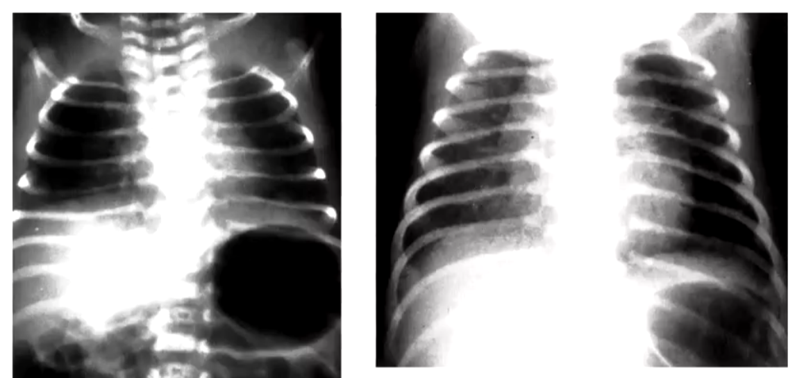 Left: Ribs and diaphragm are too flat