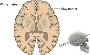 Brain and spinal cord tissue that appears gray with the naked eye; consists mainly of neuronal cell bodies (nuclei), and lacks myelinated axons